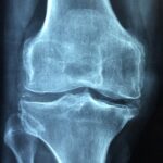 Despre osteoporoza
