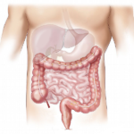 Cancerul colorectal