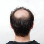Consens privind administrarea off label de minoxidil în doză mică în unele cazuri de alopecie