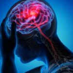 Tratamentul migrenei cronice la adult