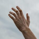 Vitiligo