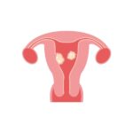 Embolizarea arterelor uterine
