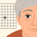 Degenerescența maculară legată de vârstă