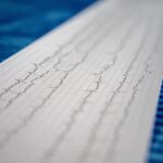 Screeningul FA la vârsta de 75 de ani: când prevenția devine cost eficientă