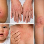 Dermatita atopică